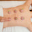 Cupping therapy set with suction pumps.